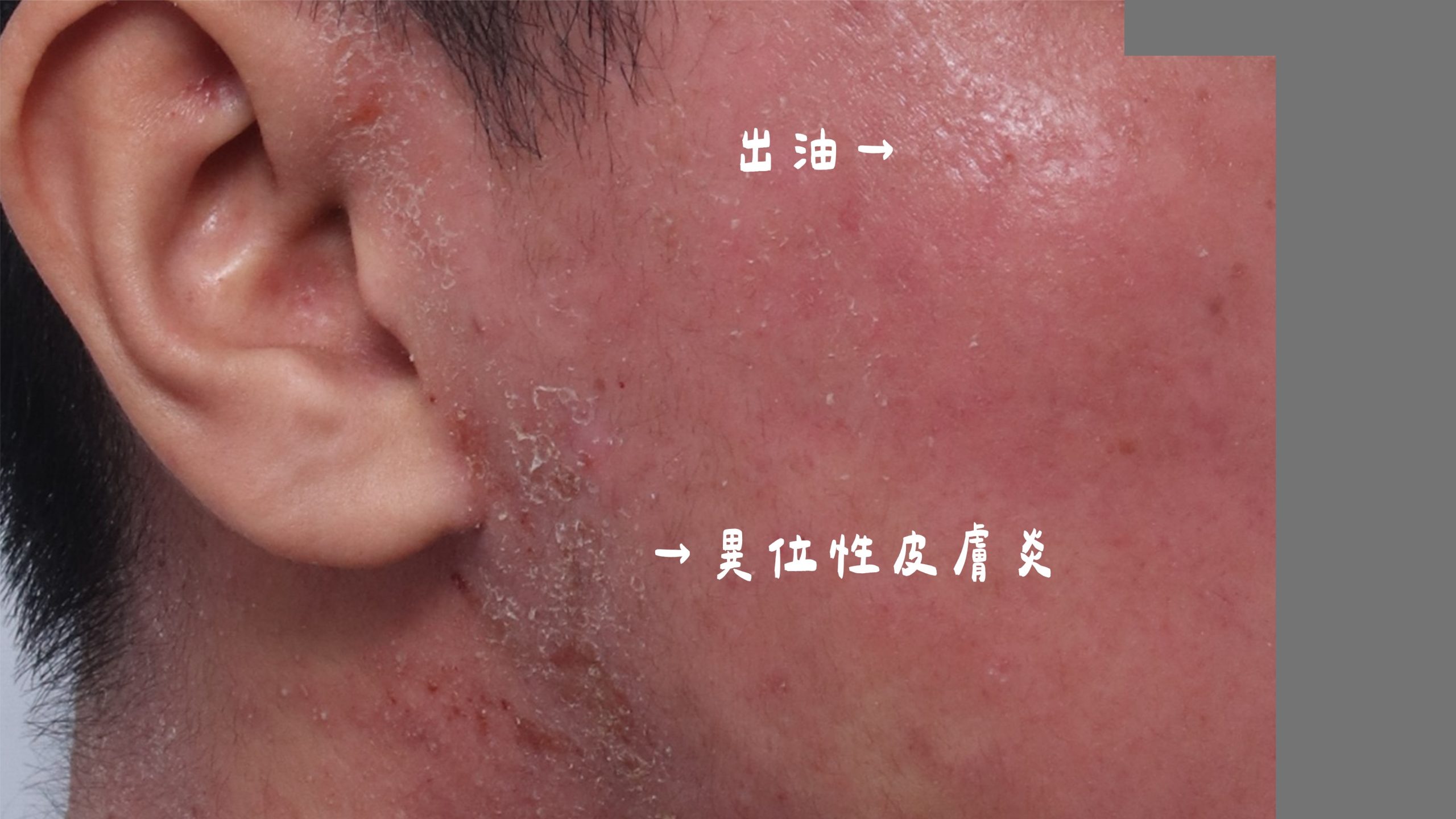 內油外乾,外由內乾,油性肌,混合肌,中性肌,皮膚出油