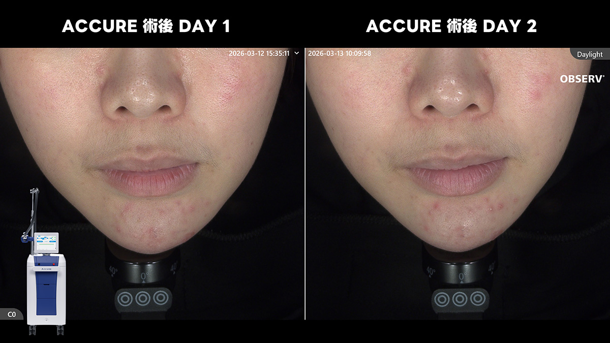 Accure,油擊雷射,痘痘,皮脂腺,油痘肌,油性肌膚,控油,外用A酸,抗痘