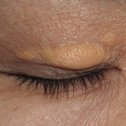 xanthelasma,眼瞼黃斑瘤,眼瞼黃色瘤,三氯醋酸,雷射,冷凍,手術