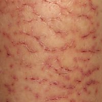 冬季癢,冬季濕疹,冬季溼疹,乾燥性皮膚炎,乾燥性濕疹,xerosis,xerotic,dermatitis,eczema,asteatotic,hiemalis