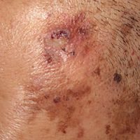 皮膚癌,skin cancer,雷射除斑,鱗狀細胞癌,squamous cell carcinoma,日光性角化症