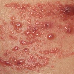 帶狀皰疹,帶狀疱疹,herpes zoster,皮蛇,shingles,斬蛇