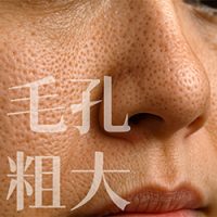 青春痘,痘痘,口服A酸,roaccutane,羅可坦,成人痘,控油,毛孔粗大,爆痘,皮脂腺分泌,痤瘡桿菌,丘疹膿皰,粉刺痘痘,果酸換膚,杏仁酸換膚,果酸煥膚,海菲秀,hydrafacial,蠕形蟎蟲,酒糟,外用A酸,毛孔,毛囊尺寸,保養品,皮膚出油,皮膚彈性,膠原蛋白,縮毛孔,水飛梭,出油,油性肌,縮小毛孔,UP雷射,皮秒雷射,淨膚雷射,ultrapulse,超脈衝雷射,PDRN,保濕