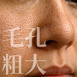 青春痘,痘痘,口服A酸,roaccutane,羅可坦,成人痘,控油,毛孔粗大,爆痘,皮脂腺分泌,痤瘡桿菌,丘疹膿皰,粉刺痘痘,果酸換膚,杏仁酸換膚,果酸煥膚,海菲秀,hydrafacial,蠕形蟎蟲,酒糟,外用A酸,毛孔,毛囊尺寸,保養品,皮膚出油,皮膚彈性,膠原蛋白,縮毛孔,水飛梭,出油,油性肌,縮小毛孔,UP雷射,皮秒雷射,淨膚雷射,ultrapulse,超脈衝雷射,PDRN,保濕