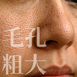 青春痘,痘痘,口服A酸,roaccutane,羅可坦,成人痘,控油,毛孔粗大,爆痘,皮脂腺分泌,痤瘡桿菌,丘疹膿皰,粉刺痘痘,果酸換膚,杏仁酸換膚,果酸煥膚,海菲秀,hydrafacial,蠕形蟎蟲,酒糟,外用A酸,毛孔,毛囊尺寸,保養品,皮膚出油,皮膚彈性,膠原蛋白,縮毛孔,水飛梭,出油,油性肌,縮小毛孔,UP雷射,皮秒雷射,淨膚雷射,ultrapulse,超脈衝雷射,PDRN,保濕