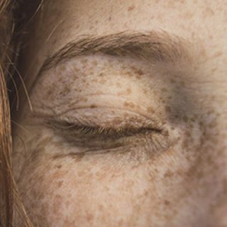 黑斑,肝斑,黑斑 治療,思膚安,矽谷電波,sylfirm,斑點,雀斑,太田母斑,顴骨母斑,曬斑,老人斑,保養品,藥物,雷射,治療斑點,外用A酸,黑色素,除斑,防曬,老化,光老化,色素沉澱,除斑雷射,雷射除斑,去除斑,消除斑點,肥胖紋,生長紋,妊娠紋,妊娠紋 治療,希思珮樂,探索皮秒,皮秒雷射,黃褐斑,荷爾蒙斑,孕斑,三合一美白藥膏,淨膚雷射,cyspera,希思佩樂,美白藥膏,傳明酸,淡化斑點,檸檬,雷射術後反黑,希斯珮樂,西斯佩樂,西思佩樂,西思珮樂,臉色黯沉,極速袪斑,去色斑,基底膜破損,微血管增生,染料雷射,585黃雷射,cyspera dark skin,sylfirm treatment,黑斑 治療方法,色素沉澱 怎麼辦,sylfirm x treatment,白斑治疗,sylfirm before and after,cysteamine,美白淡斑,膚色暗沉,皮膚暗沉,皮膚黯沉,膚色黯沉,膚色不均,保濕,中胚層療法,肝斑 治療方法,肝斑 雷射,黑斑 雷射,Nobleen,Red touch,顴骨斑