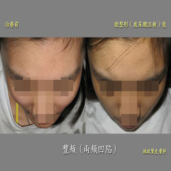 豐頰,臉頰凹陷,玻尿酸,微晶瓷,喬雅登,voluma,juvederm,水微晶,安緹斯,微整形,微整型,高雄皮膚科